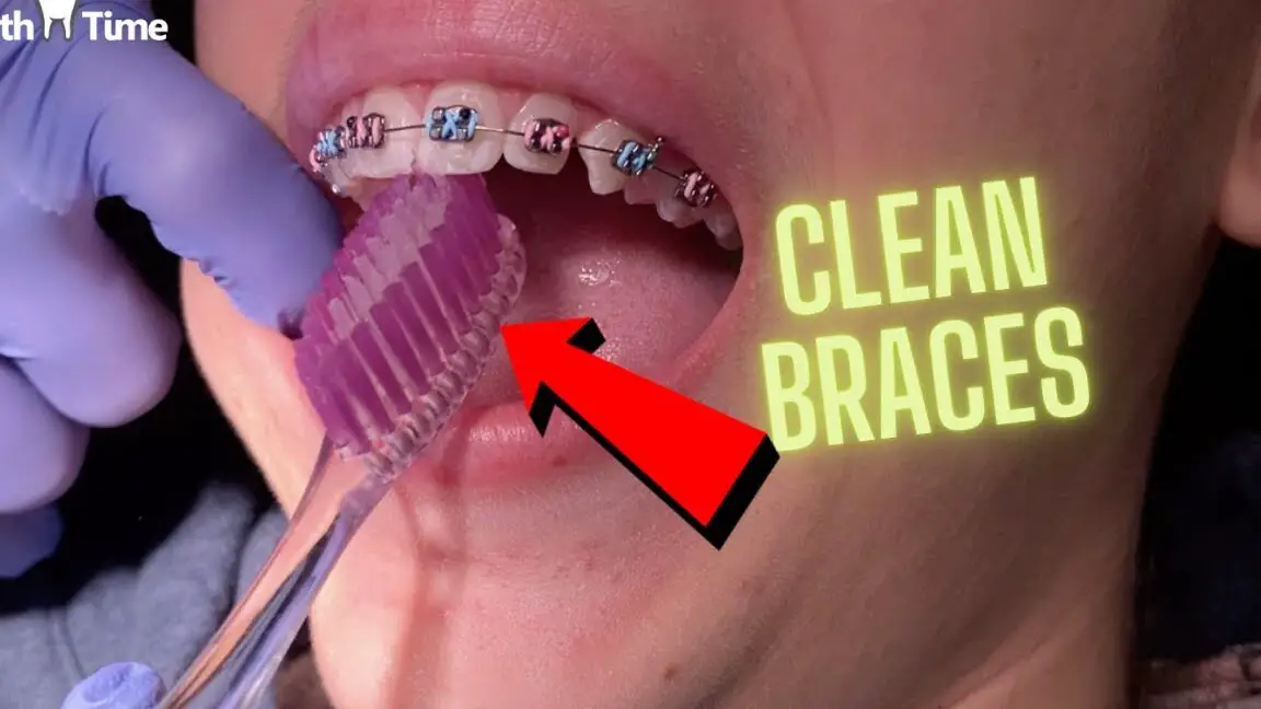 Cómo mantener limpios mis frenillos - Herramientas de limpieza de frenillos - ¿Cómo cepillarme los dientes con frenillos?